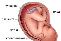 भ्रूण हाइपोक्सिया: बच्चे के लिए परिणाम अंतर्गर्भाशयी भ्रूण हाइपोक्सिया निदान नैदानिक ​​​​अभिव्यक्तियों का कारण बनता है