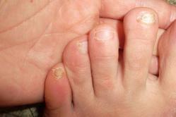 Как точно распознать грибок ногтей на ногах и когда начинать лечение?